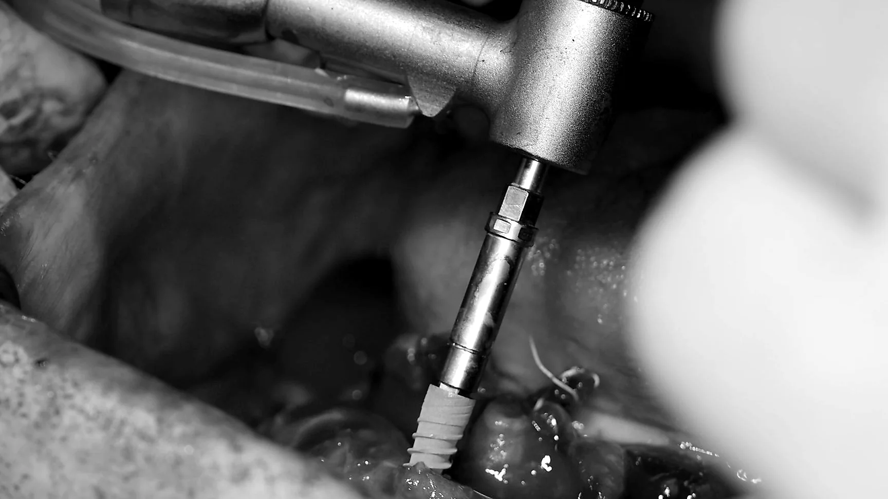 Black-and-white close view of dental implant placement during surgery.