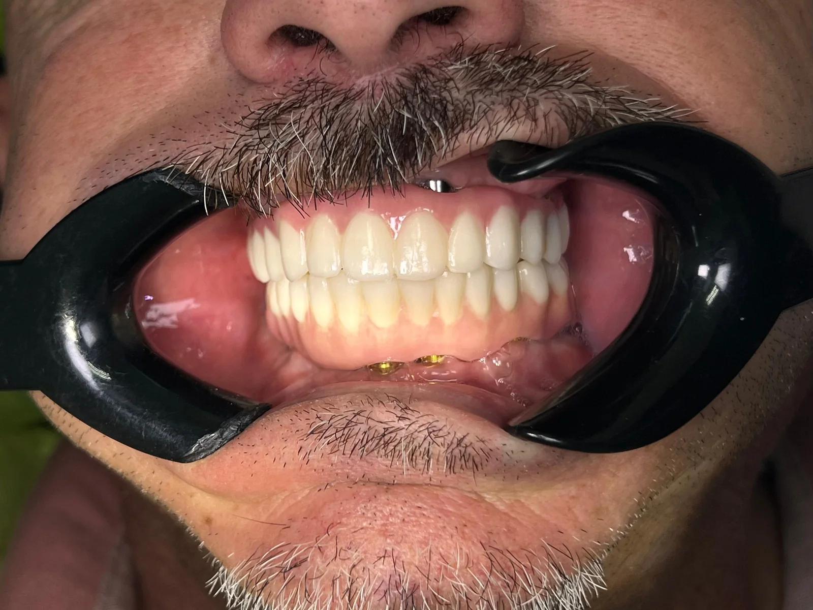 Oblique view of the final result with All-on-X zirconia bars.