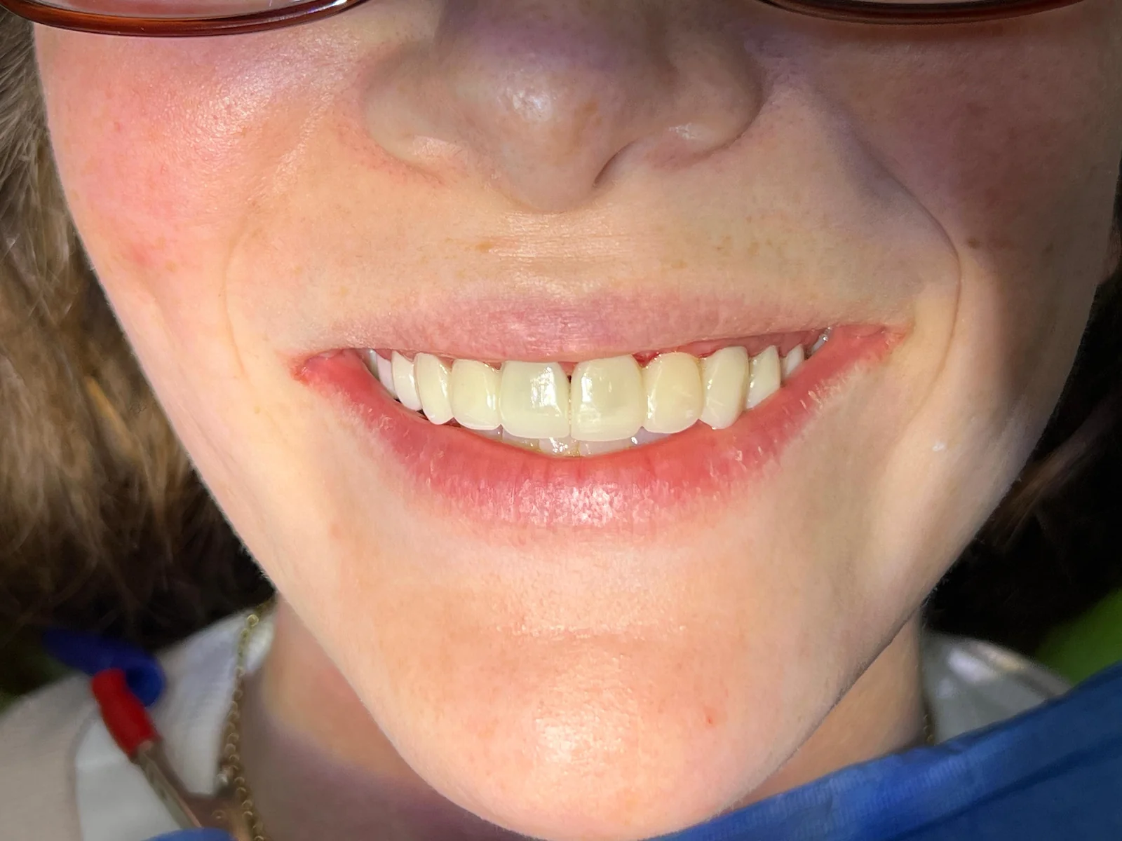 Smile during the process of a full-mouth rehabilitation.