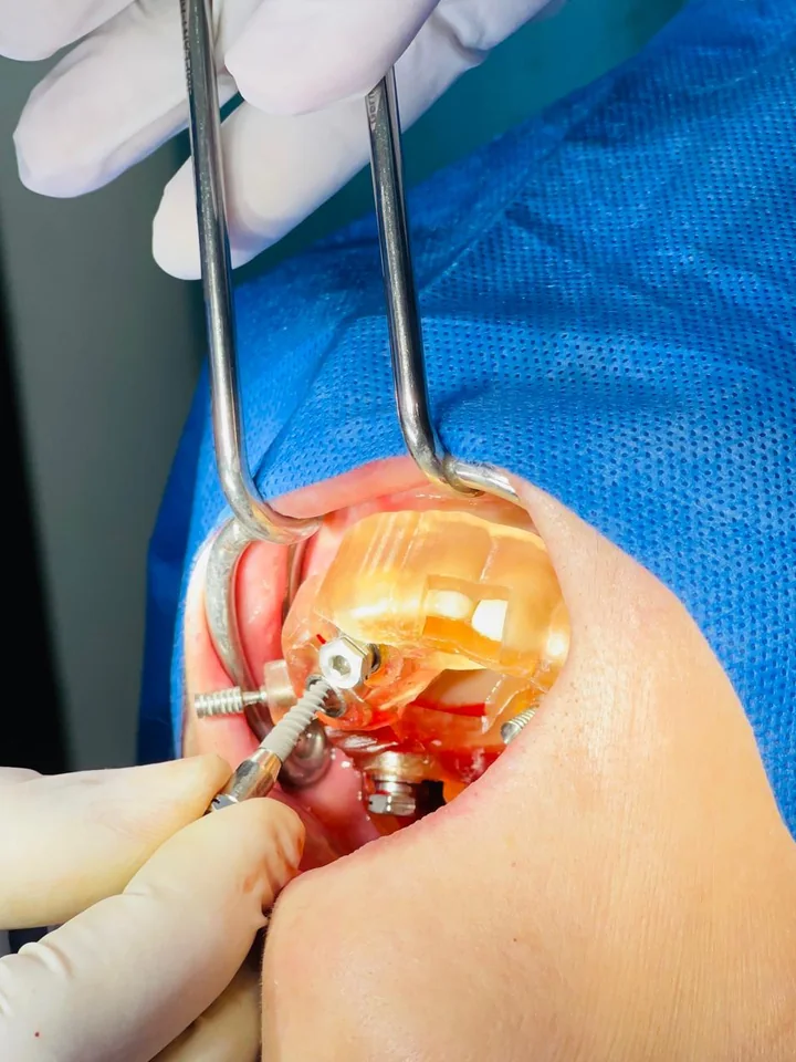 Close view of a real guided dental implant surgery procedure.
