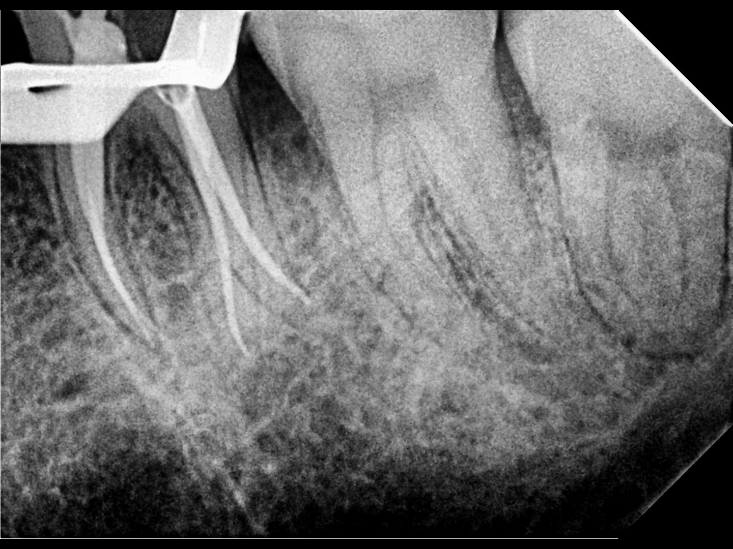 Clinical radiograph from a root canal treatment performed at Ramos Dental.
