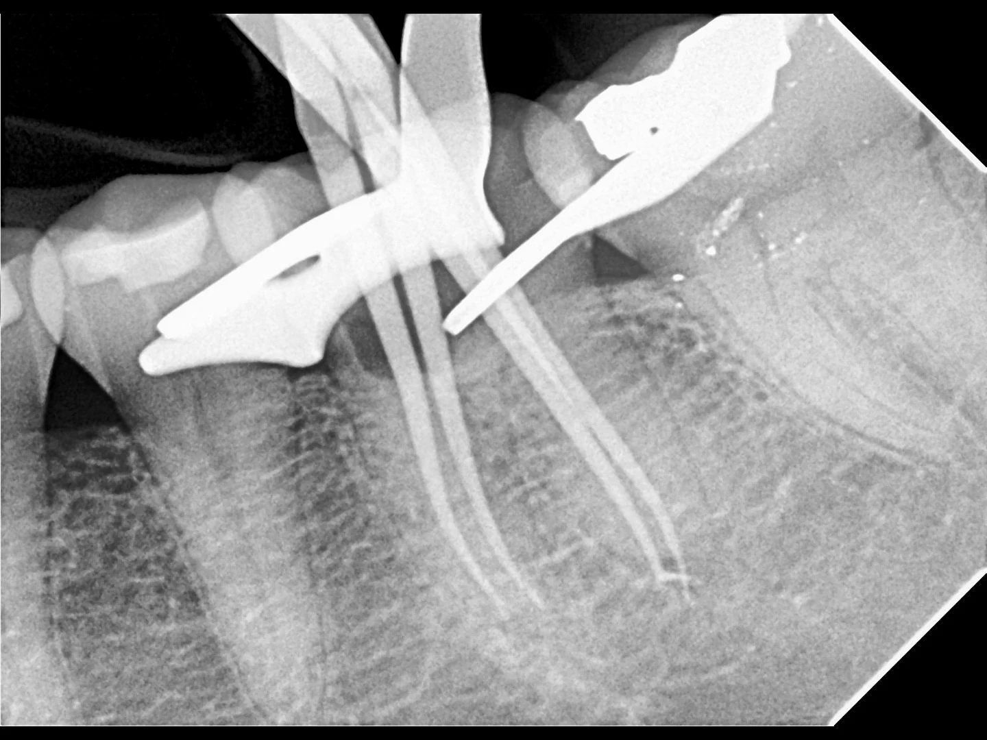 Clinical radiograph from a root canal treatment performed at Ramos Dental.