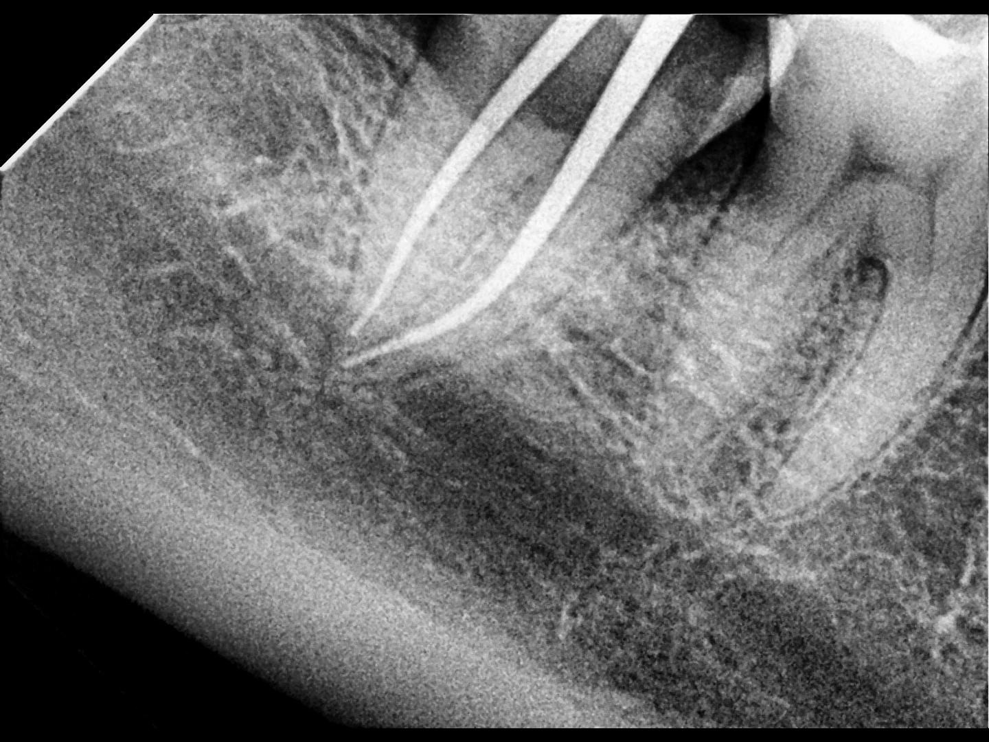 Clinical radiograph from a root canal treatment performed at Ramos Dental.
