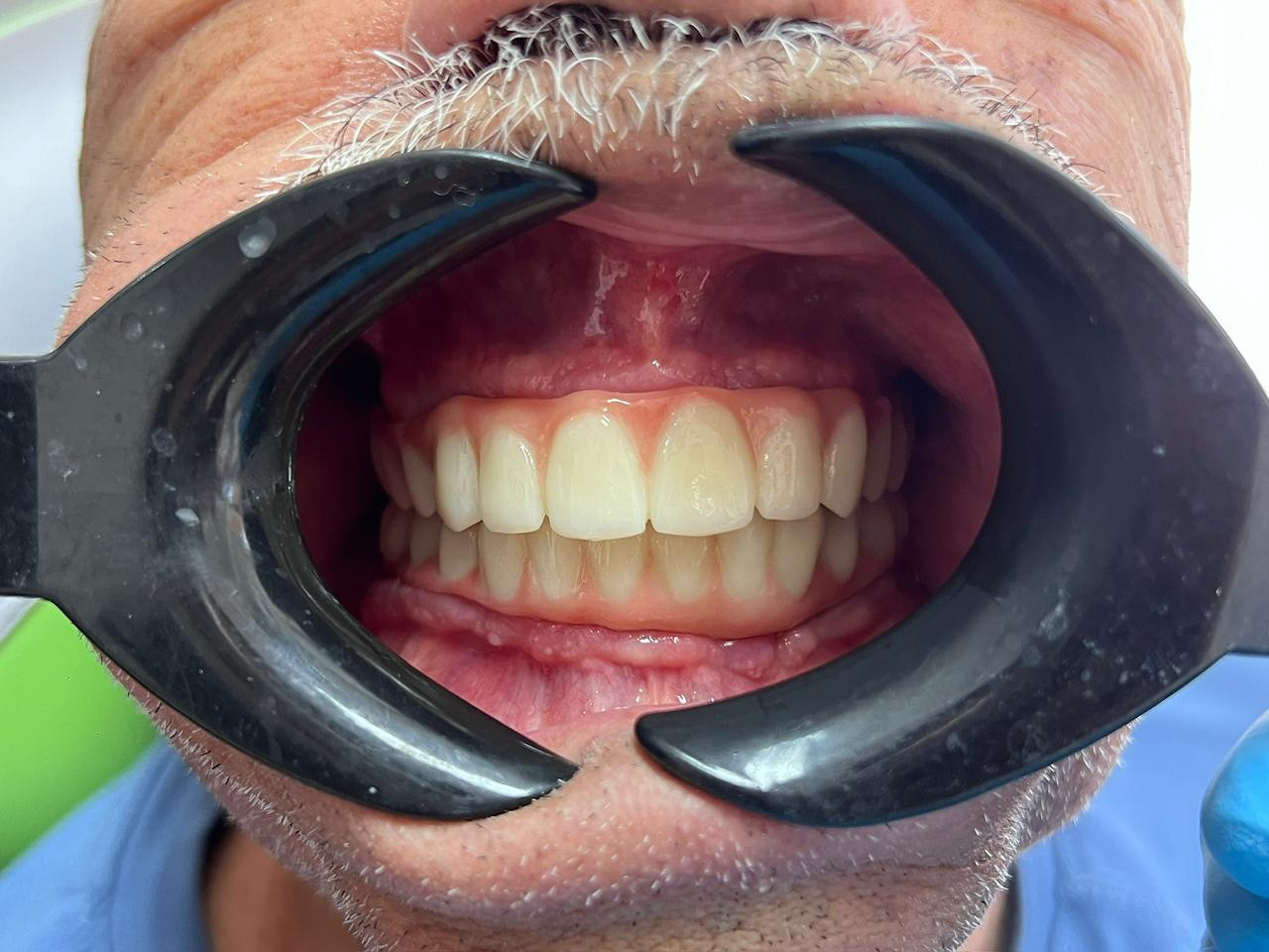 Front view of immediate-load temporary All-on-X restorations.
