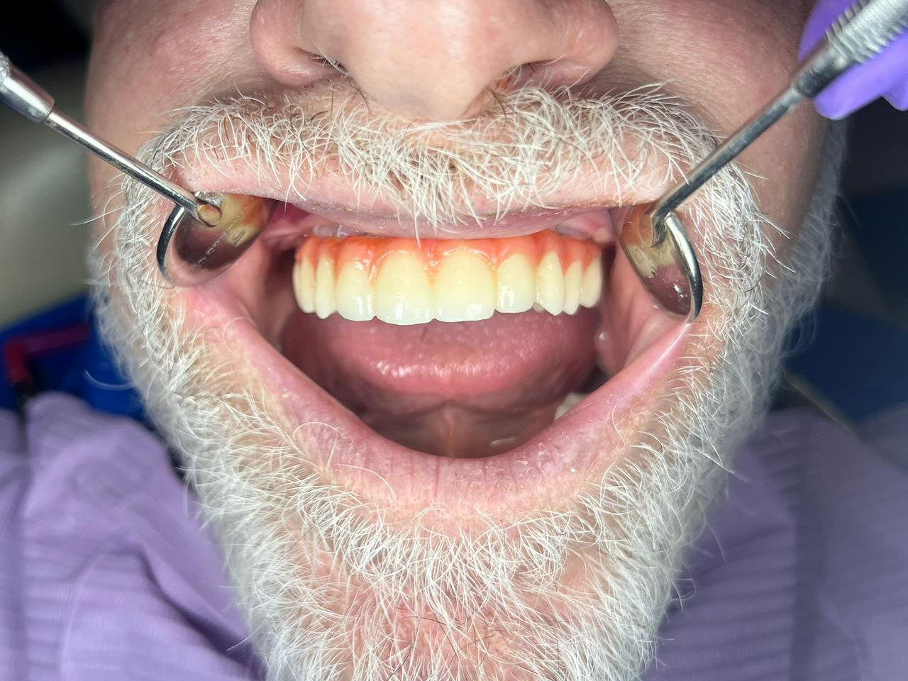 Clinical view of immediate-load temporary All-on-X restorations.