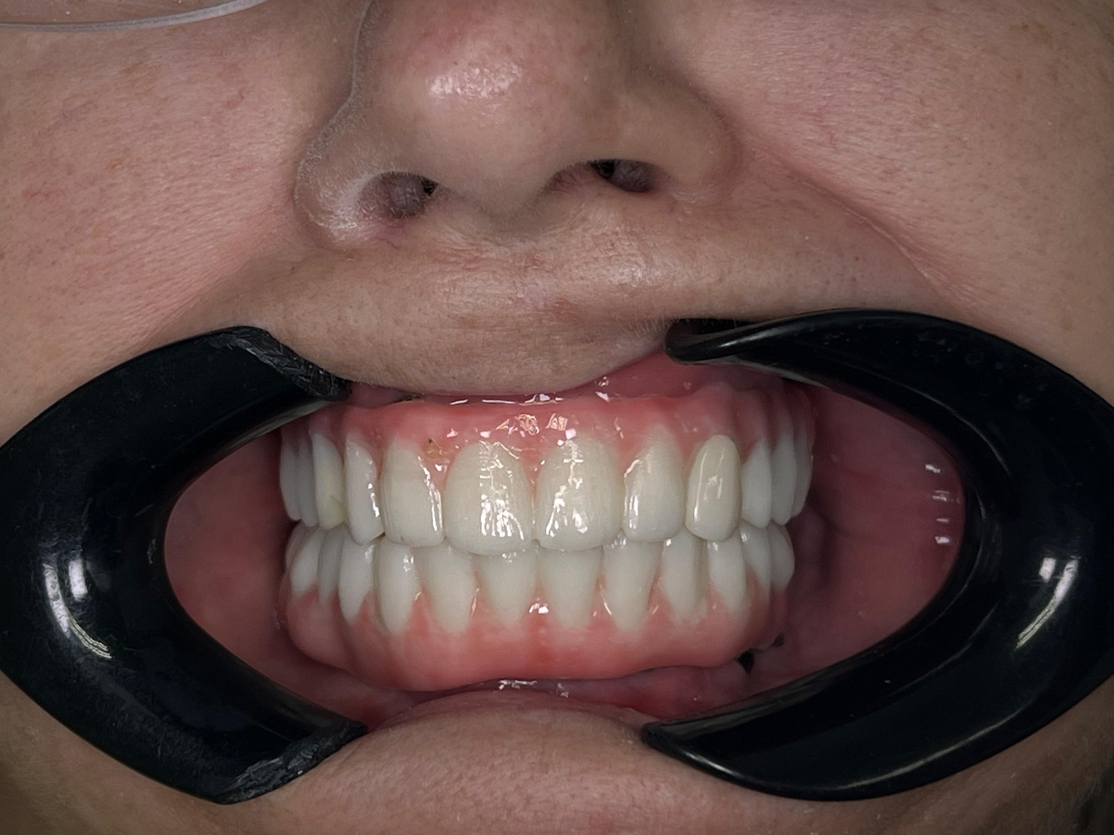 Front view of the final result with All-on-X zirconia bars.