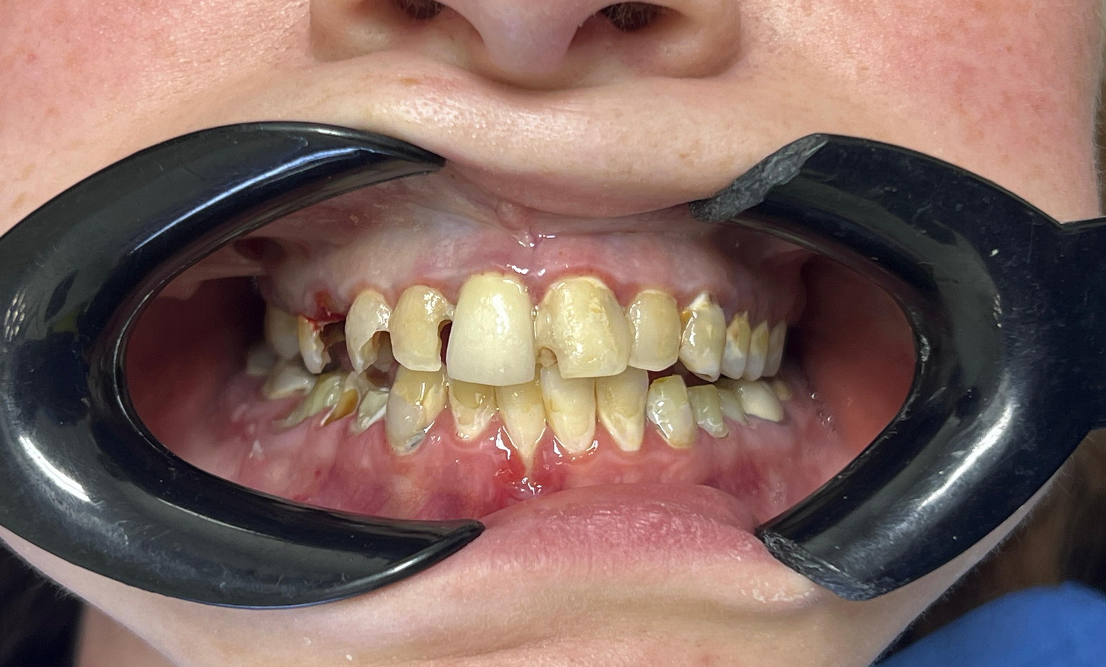 Initial clinical photograph of a full-mouth rehabilitation case.