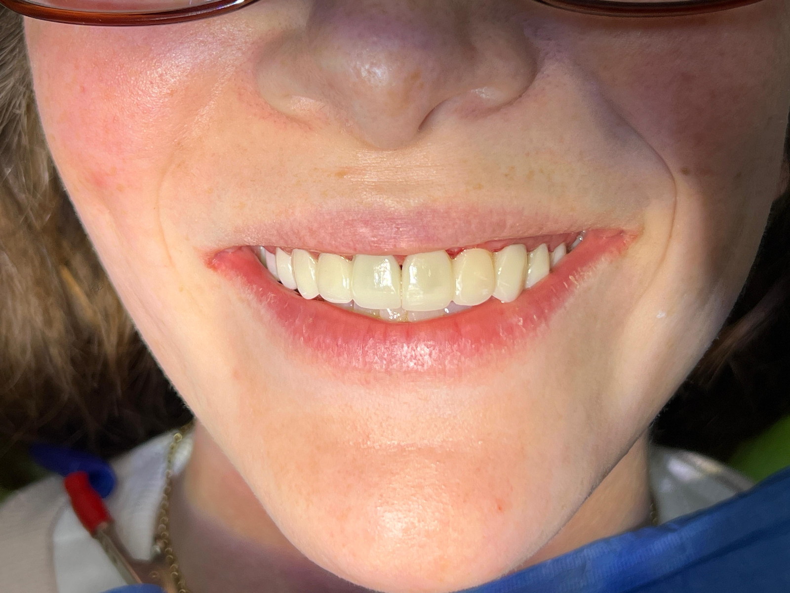 Smile during the process of a full-mouth rehabilitation.