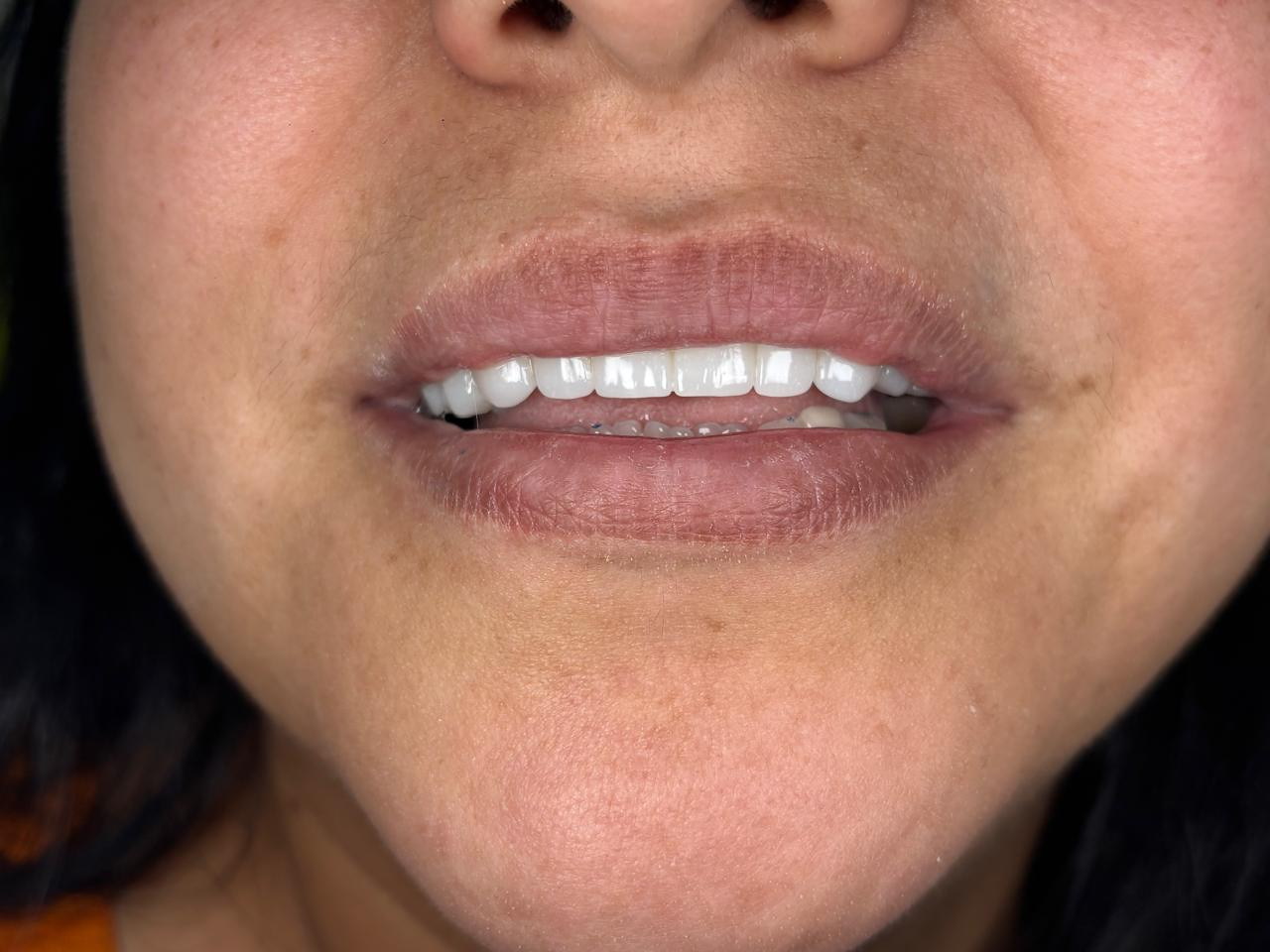 Final natural-smile result of a digital smile design case.