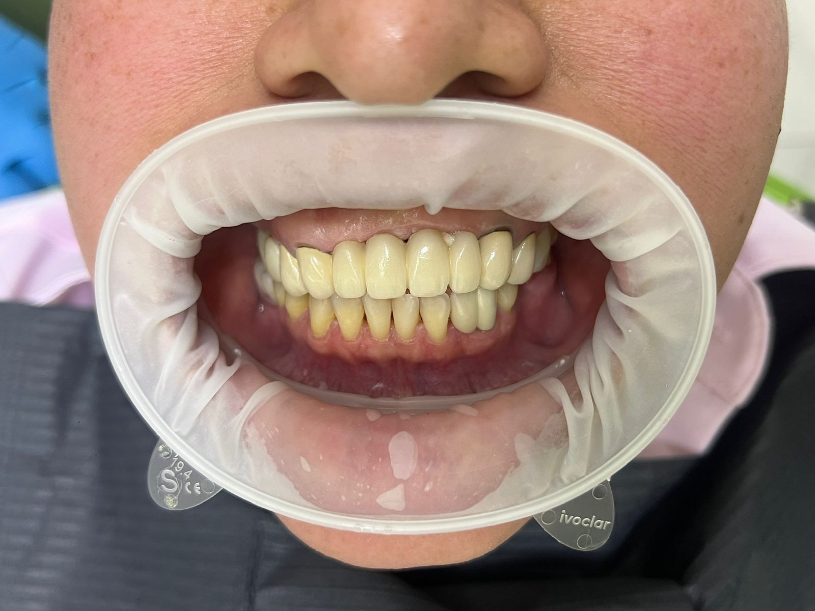 Initial clinical photograph of a digital smile design case.